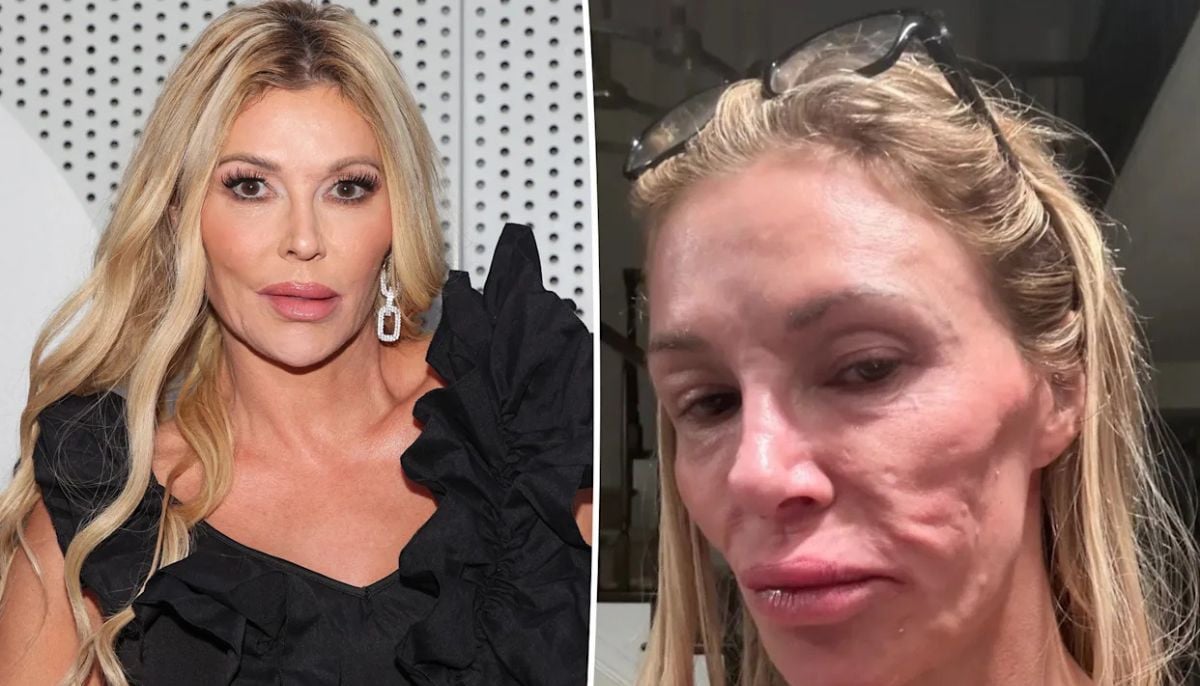 Brandi Glanville continues two-year battle with mysterious facial disfigurement