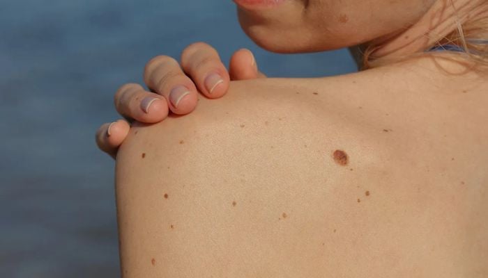 Why DIY mole removal is 'dangerous shortcut' you must avoid