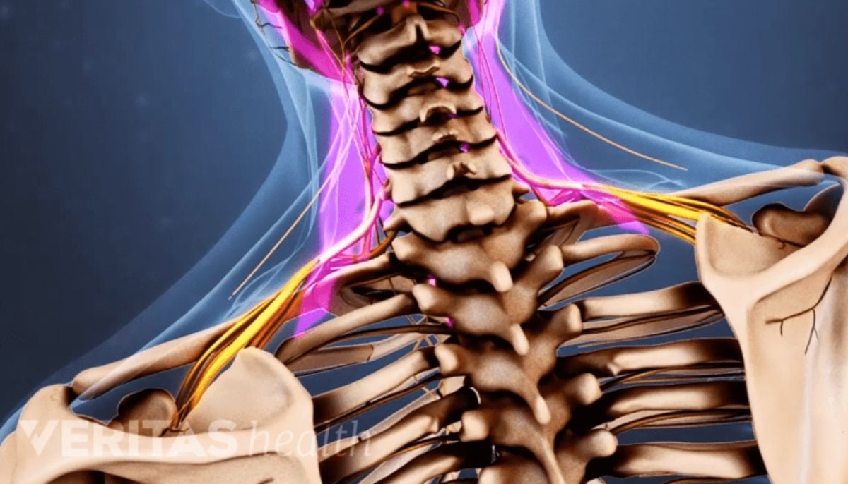 Could a quick neck pop cause a stroke? The hidden vascular risks revealed