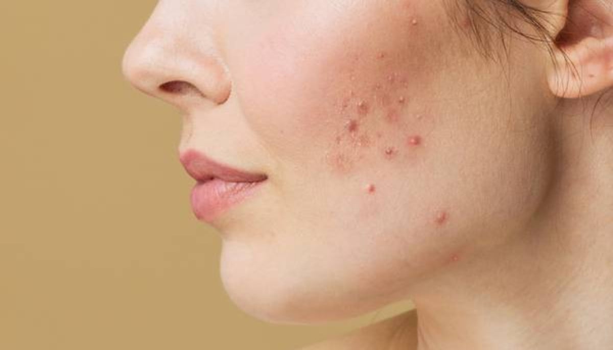 Expert-recommended tips to get rid of red and irritated acne