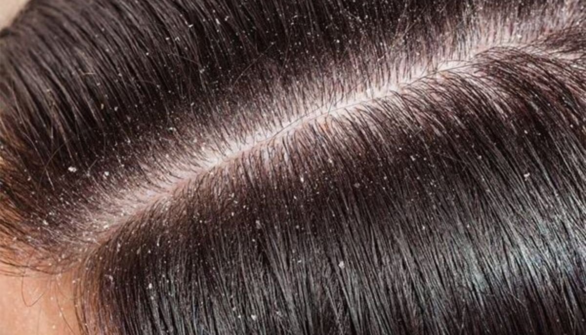 Experts debunk common hygiene myths surrounding recurring dandruff flakes