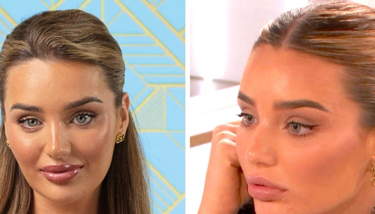 Lucinda Strafford praised for revealing 'real skin' during painful lip filler treatment