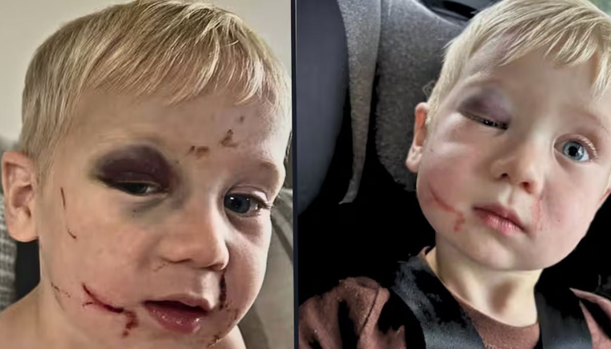 Daycare worker allegedly forces boy into 'criss-cross applesauce,' breaking shinbone and ankle