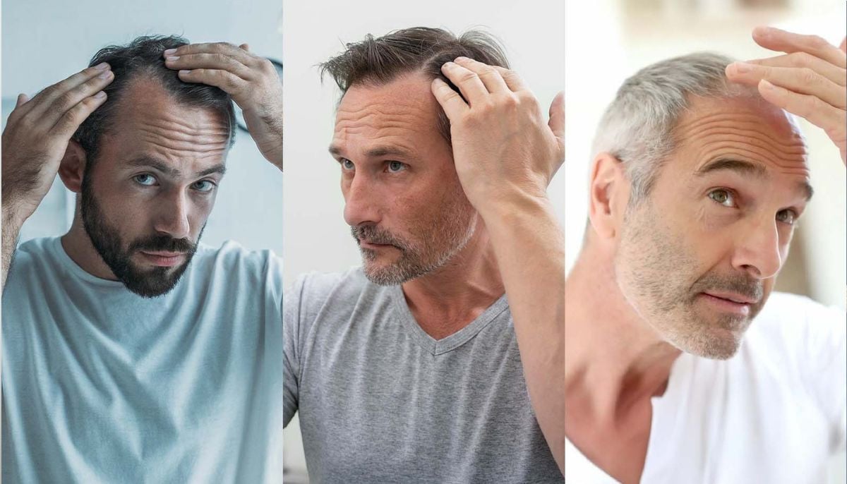 How to identify if you are suitable candidate for hair transplant