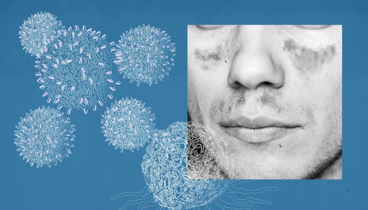 Expert explains reality behind viral claims linking people pleasing to autoimmune disease