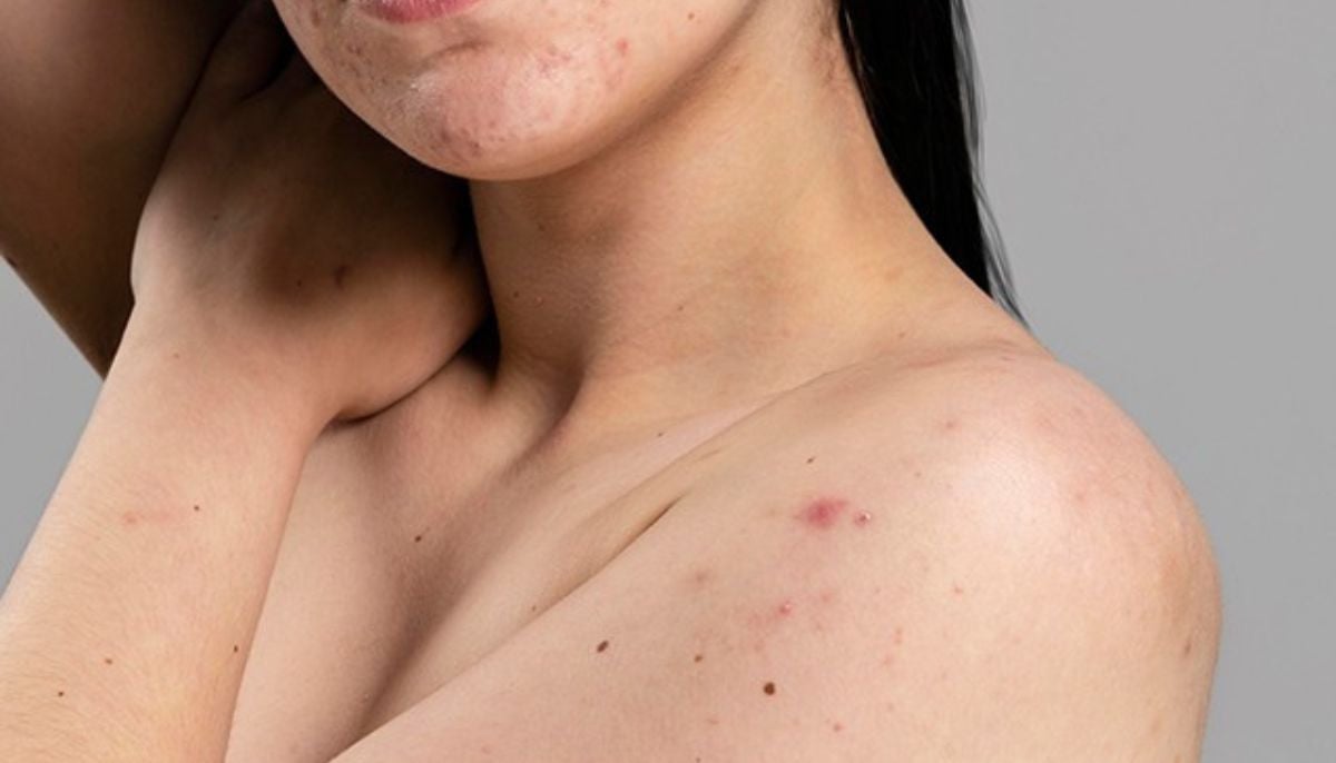 Explore effective treatments for stubborn body acne