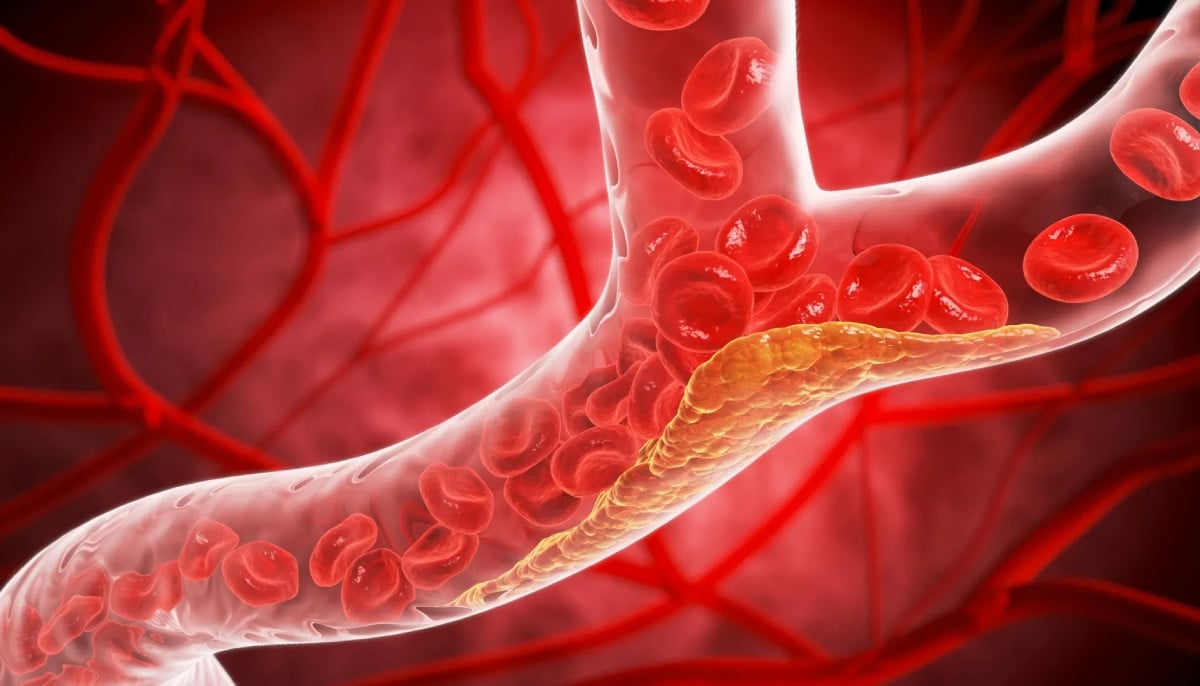 Early study suggests major advance in cholesterol control and heart disease prevention