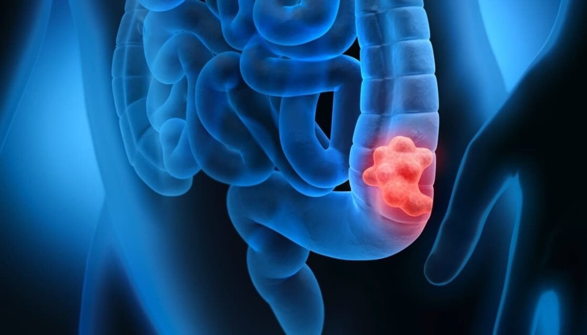 Colorectal cancer trends worsen among youth as experts call for urgent screening