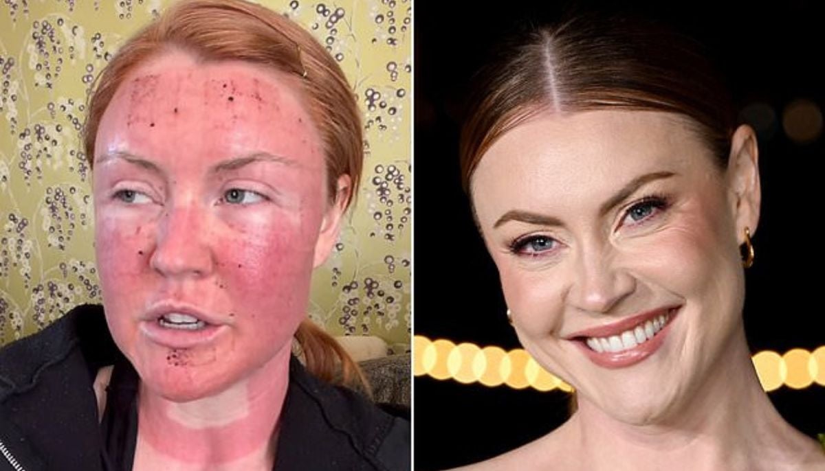 Camilla Kerslake shares shocking facial swelling following intense skin laser procedure