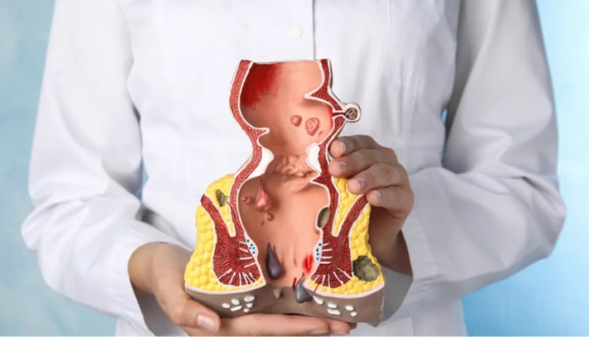New clinical advice shows how small habits may help prevent and manage hemorrhoids