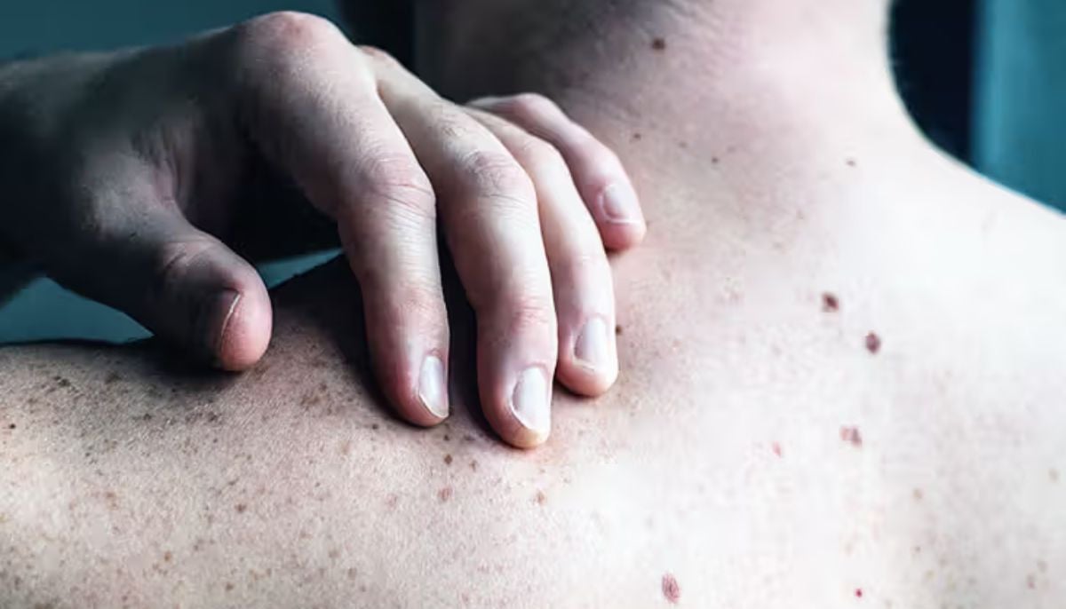 Doctor warns that tiny harmless-looking skin spots could be early signs of deadly skin cancer