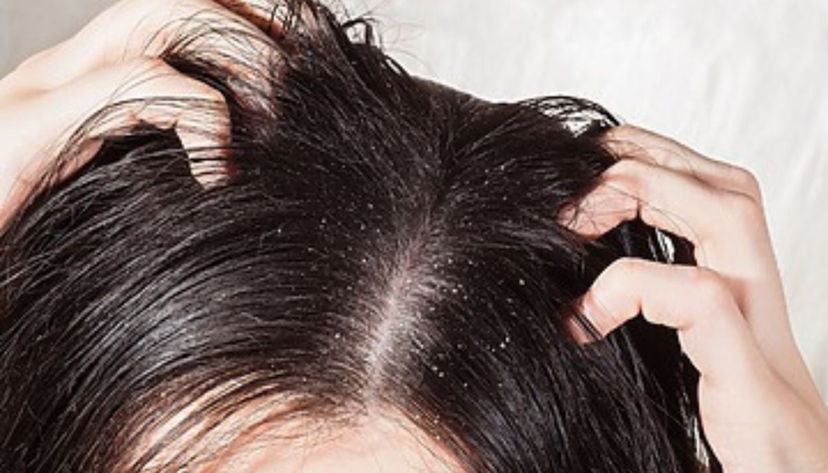 Greasy flakes on your scalp and nose could be seborrheic dermatitis, says dermatologist