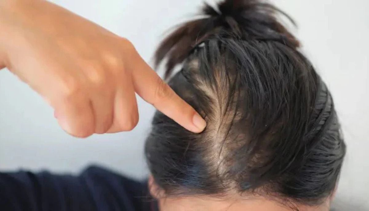 Doctor explains why young adults are losing hair earlier than ever before