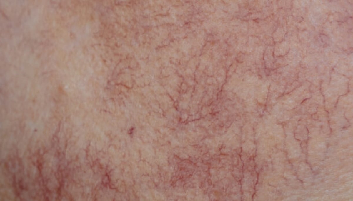 Visible veins with age? 4 common reasons explained