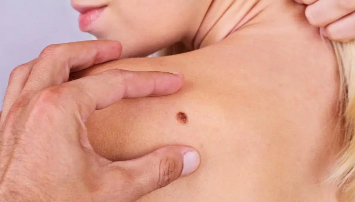 AI app detects skin cancer using only smartphone camera