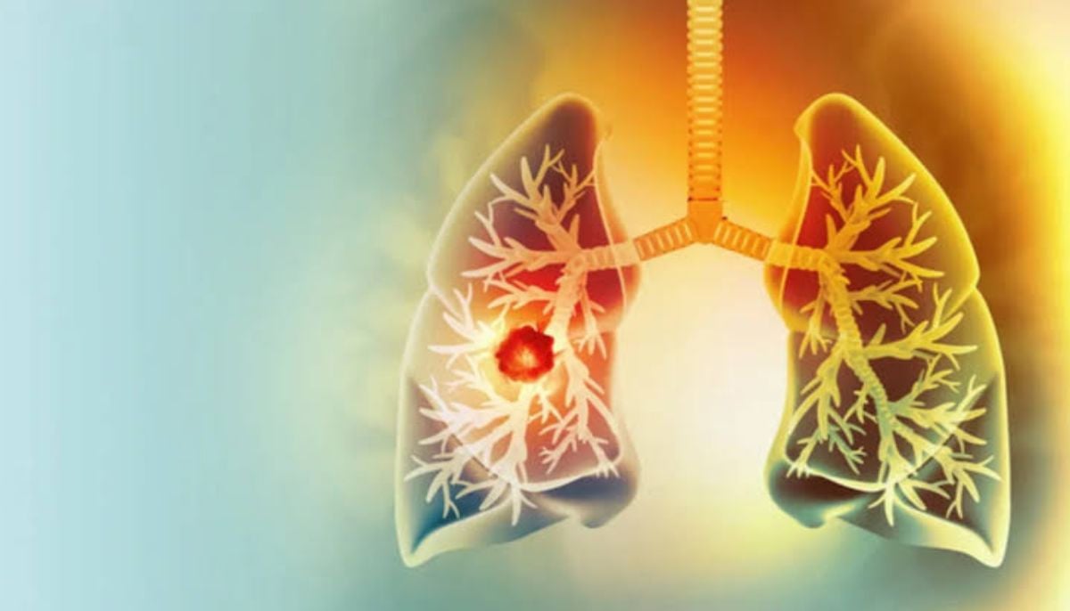 Young non-smoker lung cancer rates rise despite healthy diets
