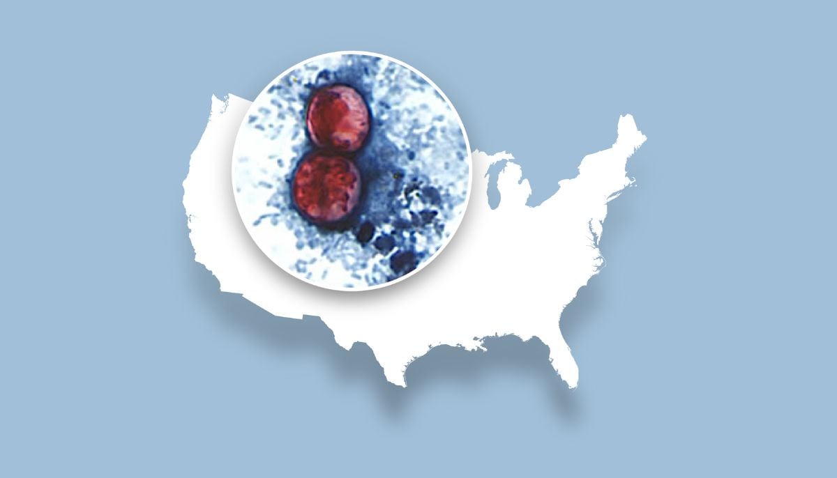 Severe parasite outbreak infects hundreds across 31 US states