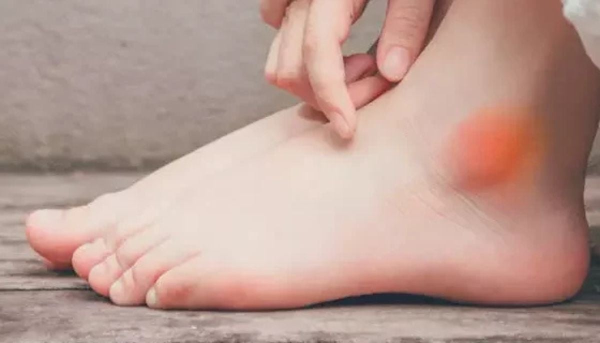 Swollen ankle indicates early stage kidney disease, urologist says