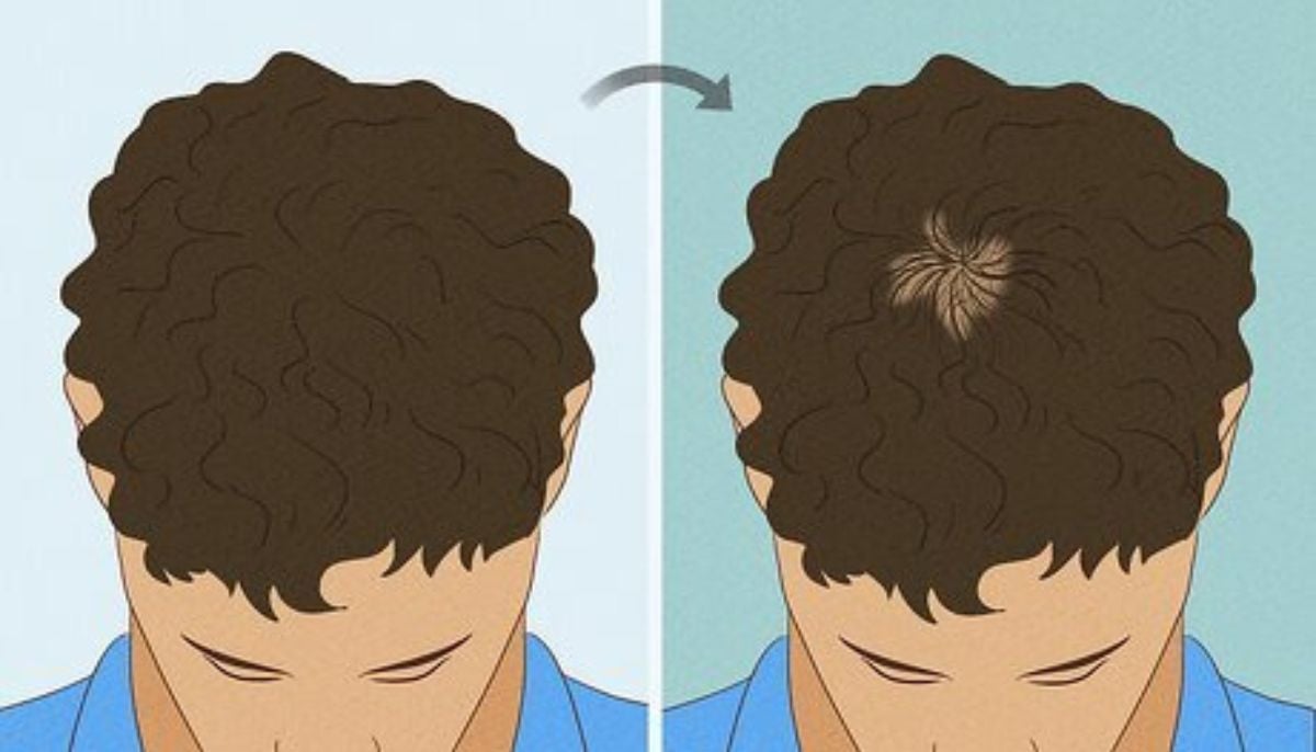 Plastic surgeon details structured hair loss assessment to prevent balding