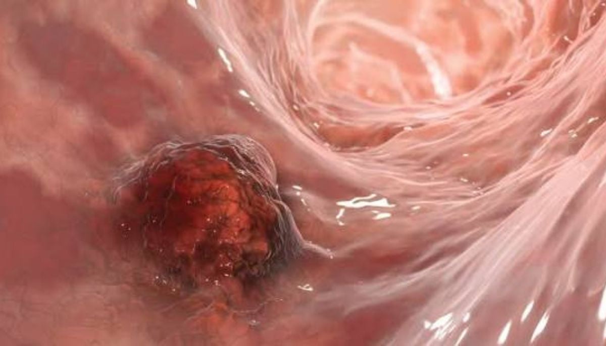 Oncologist warns rising colorectal cancer rates affect younger adults globally