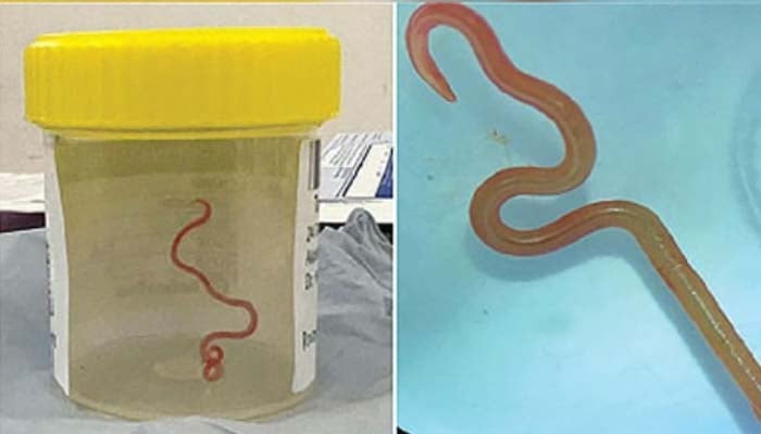 Live parasitic worm found in Australian womans brain stuns doctors