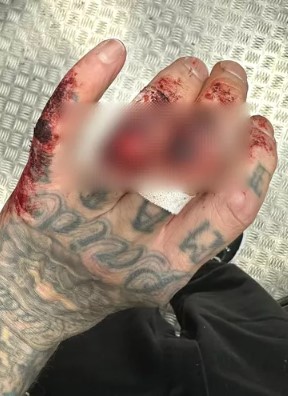 Travis Barker shocks fans with horrific hand injury following Blink-182 concert