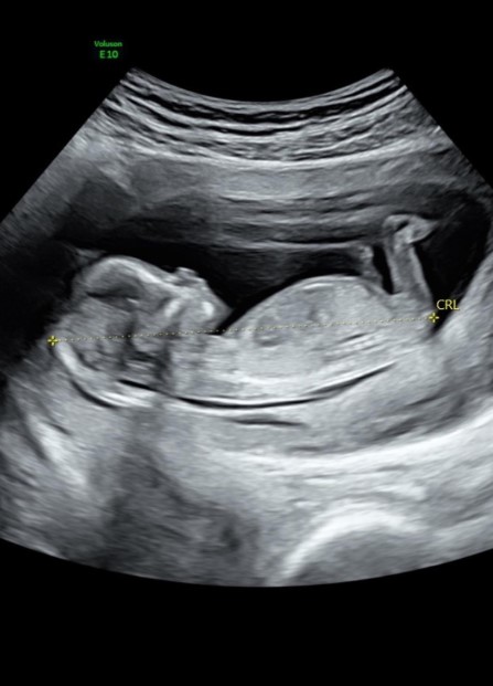 Nick Viall speaks on challenges of Special Forces amid fiancée Natalie Joys pregnancy