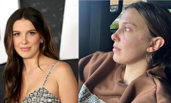 Millie Bobby Brown earns praise for sharing her 'journey with acne'