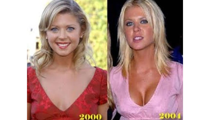 From Botox to nose jobs: How cosmetic surgery became a Hollywood obsession