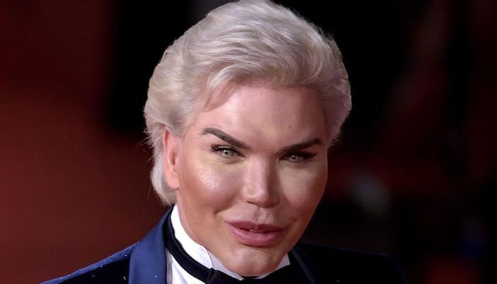 Celebrities and their Botox blunders: Stars whose facial fillers gone terribly wrong