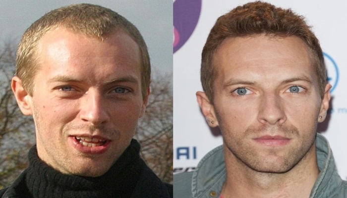 Shockingly undetectable hair transplants of your favourite male celebrities