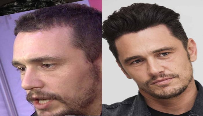 Shockingly undetectable hair transplants of your favourite male celebrities