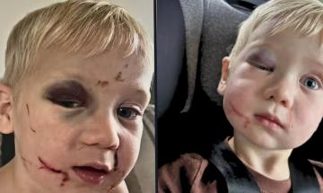 Daycare worker allegedly forces boy into 'criss-cross applesauce,' breaking shinbone and ankle