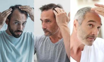 How to identify if you are suitable candidate for hair transplant