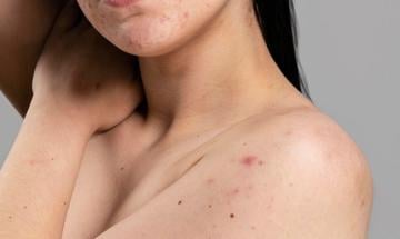 Explore effective treatments for stubborn body acne
