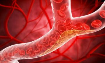 Early study suggests major advance in cholesterol control and heart disease prevention