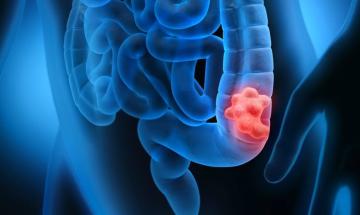 Colorectal cancer trends worsen among youth as experts call for urgent screening