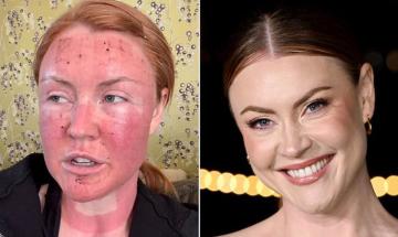 Camilla Kerslake shares shocking facial swelling following intense skin laser procedure