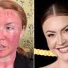 Camilla Kerslake shares shocking facial swelling following intense skin laser procedure