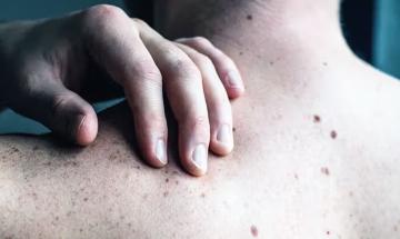 Doctor warns that tiny harmless-looking skin spots could be early signs of deadly skin cancer