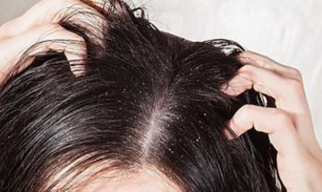 Greasy flakes on your scalp and nose could be seborrheic dermatitis, says dermatologist