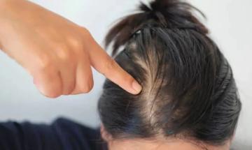 Doctor explains why young adults are losing hair earlier than ever before