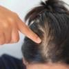 Doctor explains why young adults are losing hair earlier than ever before