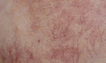 Visible veins with age? 4 common reasons explained