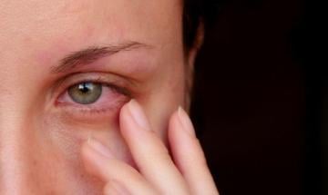 Watery eyes could signal dry eye disease, not good health, ophthalmologist warns