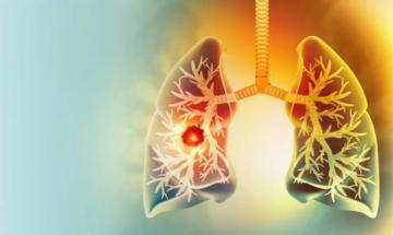 Young non-smoker lung cancer rates rise despite healthy diets