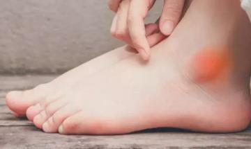 Swollen ankle indicates early stage kidney disease, urologist says
