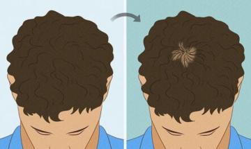 Plastic surgeon details structured hair loss assessment to prevent balding